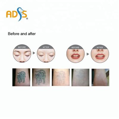 Laser de c4q conmutado Pico Laser Tattoo Removal Machine 1064nm 532nm del Nd Yag